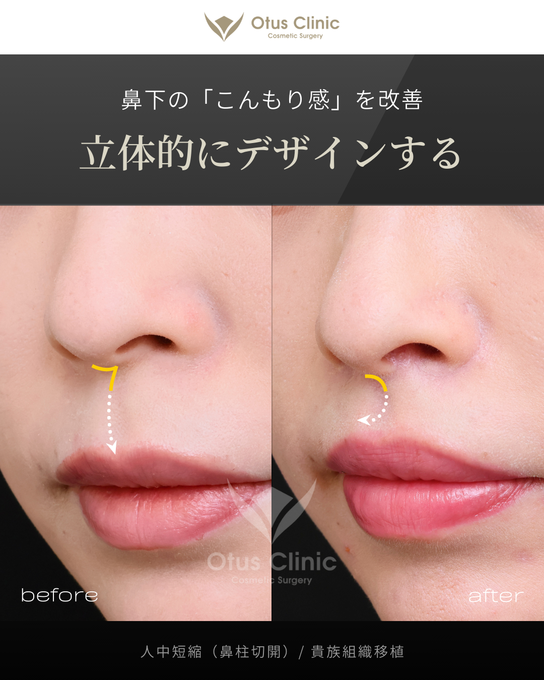 鼻柱切開人中短縮・貴族組織移植