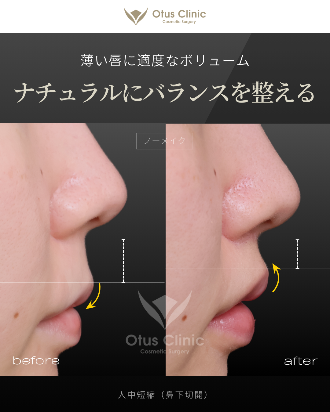 人中短縮（鼻下切開）