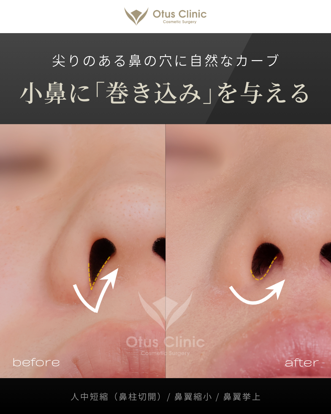 鼻柱切開人中短縮・鼻翼縮小・鼻翼挙上