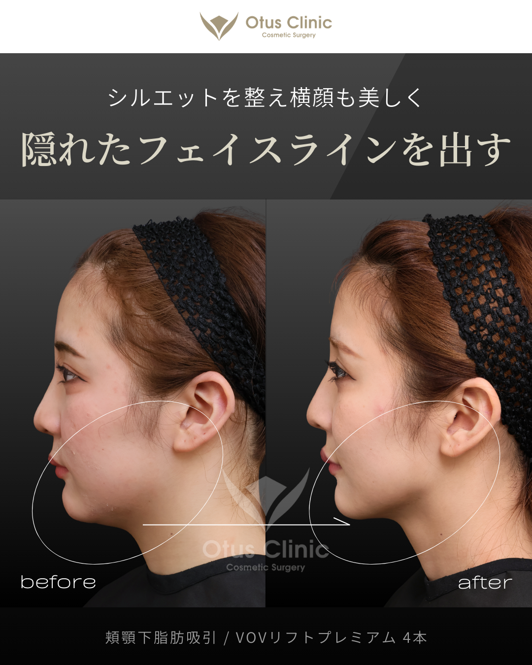 頬顎下脂肪吸引・VOVリフトプレミアム４本
