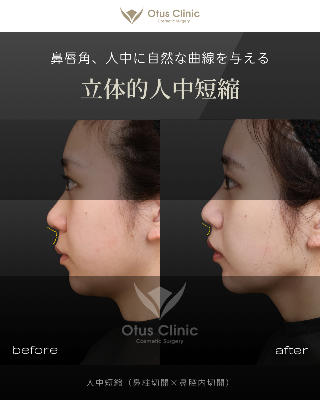 人中短縮(鼻柱切開×鼻腔内切開)