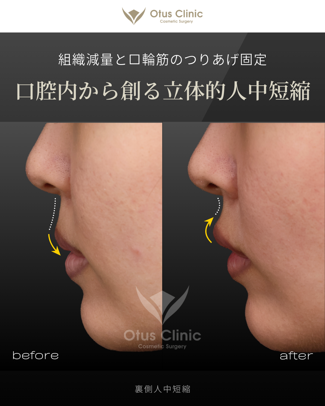 裏側人中短縮（切らない人中短縮）