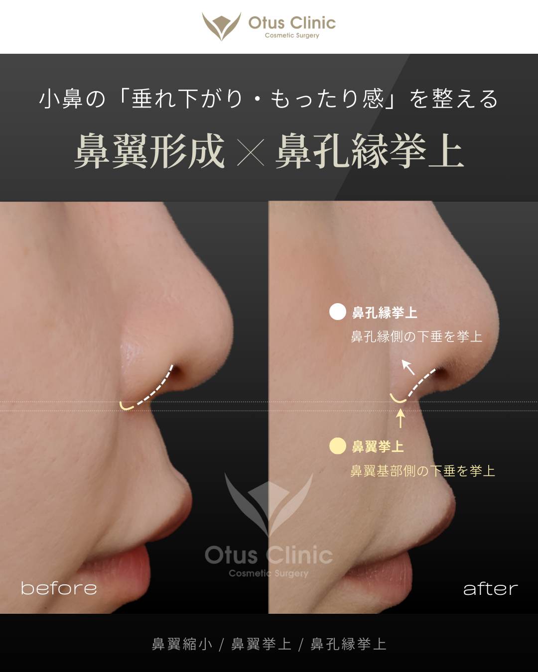 鼻翼縮小・鼻翼挙上・鼻孔縁挙上