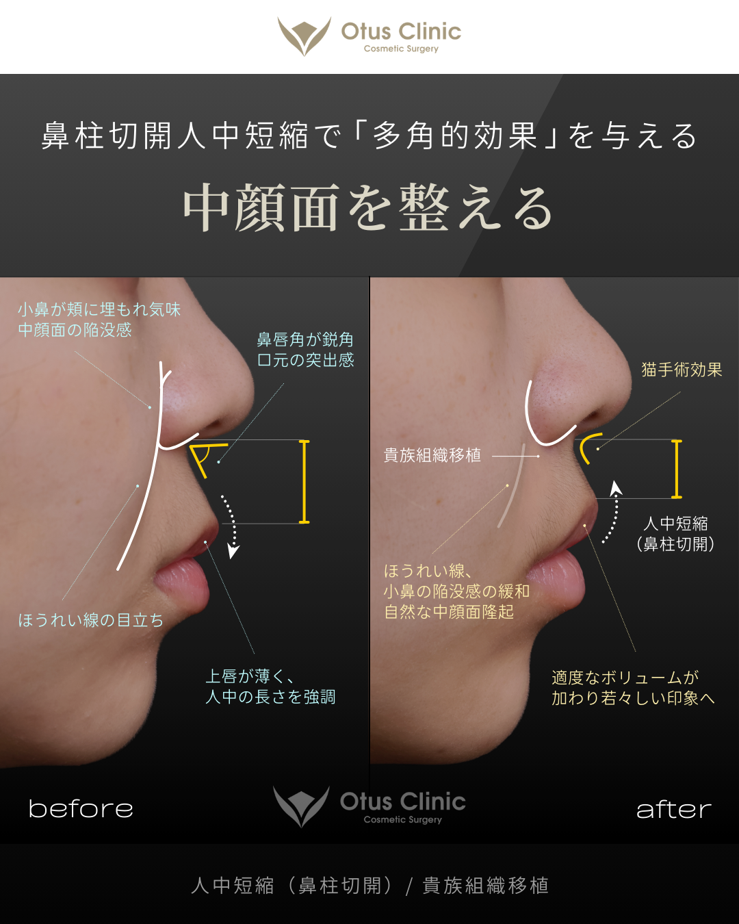 鼻柱切開人中短縮・貴族組織移植