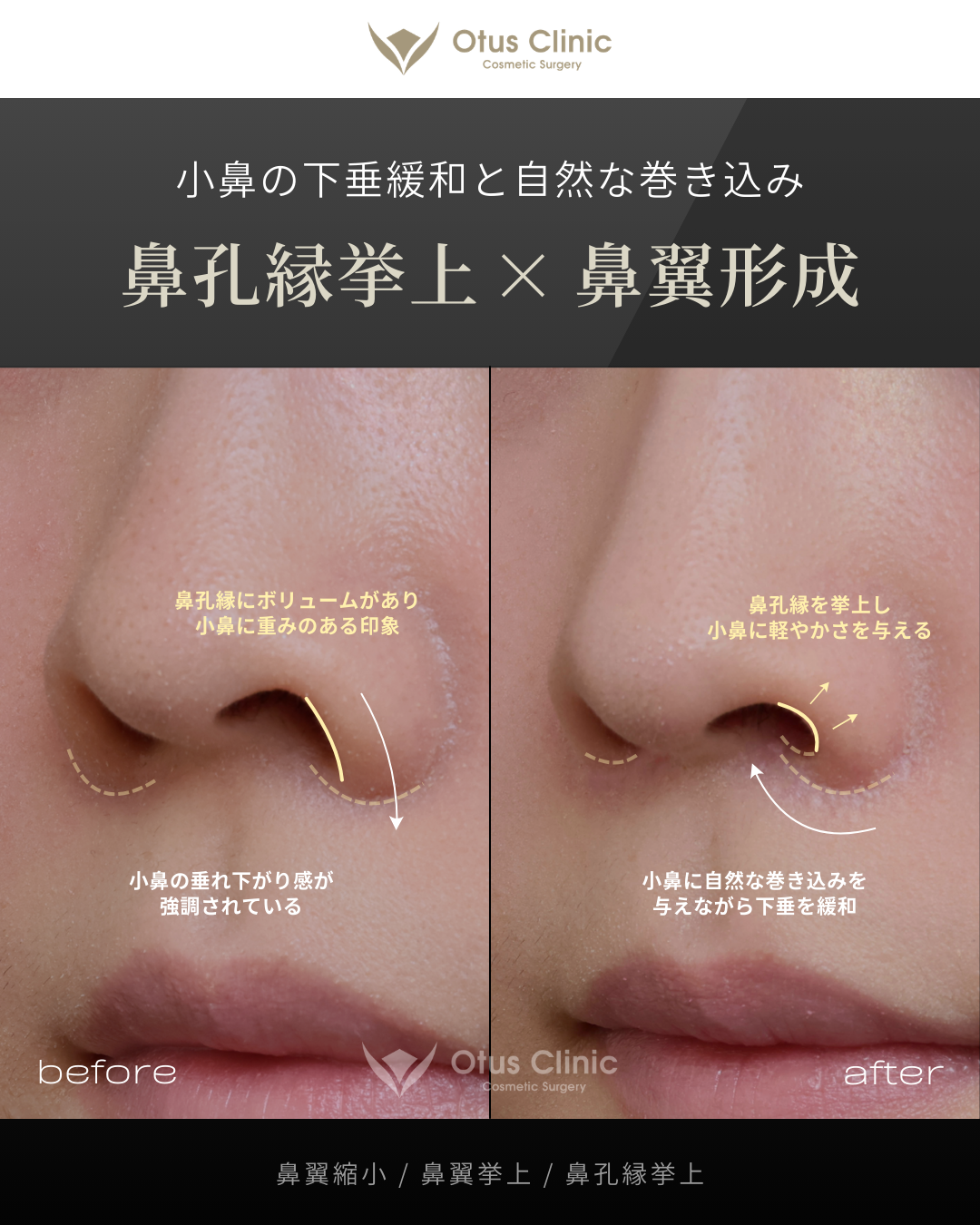 鼻翼縮小・鼻翼挙上・鼻孔縁挙上