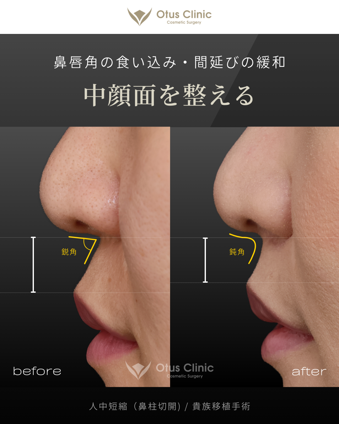 鼻柱切開人中短縮・ 貴族組織移植