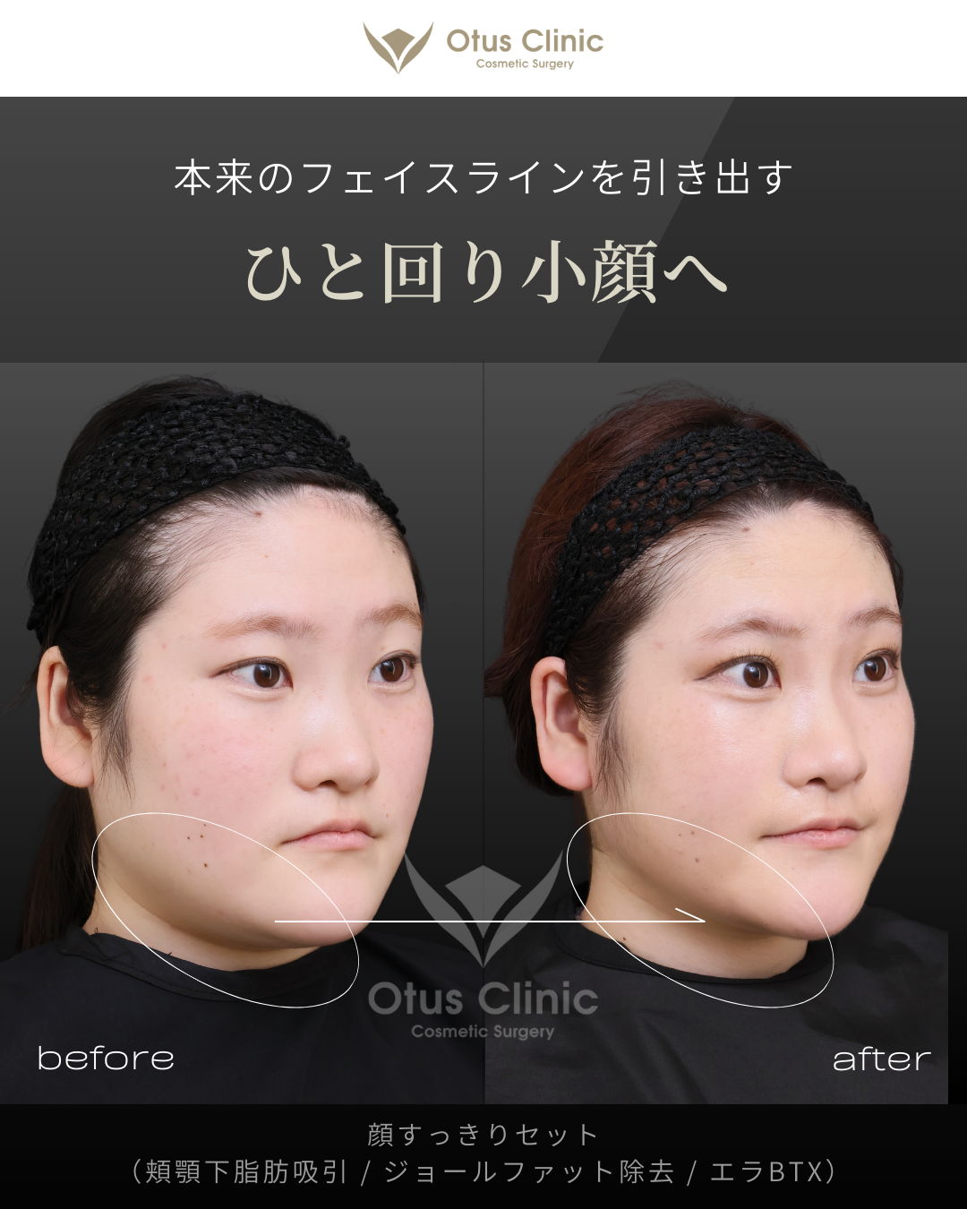 頬顎下脂肪吸引 ・ジョールファット除去 ・ エラBTX