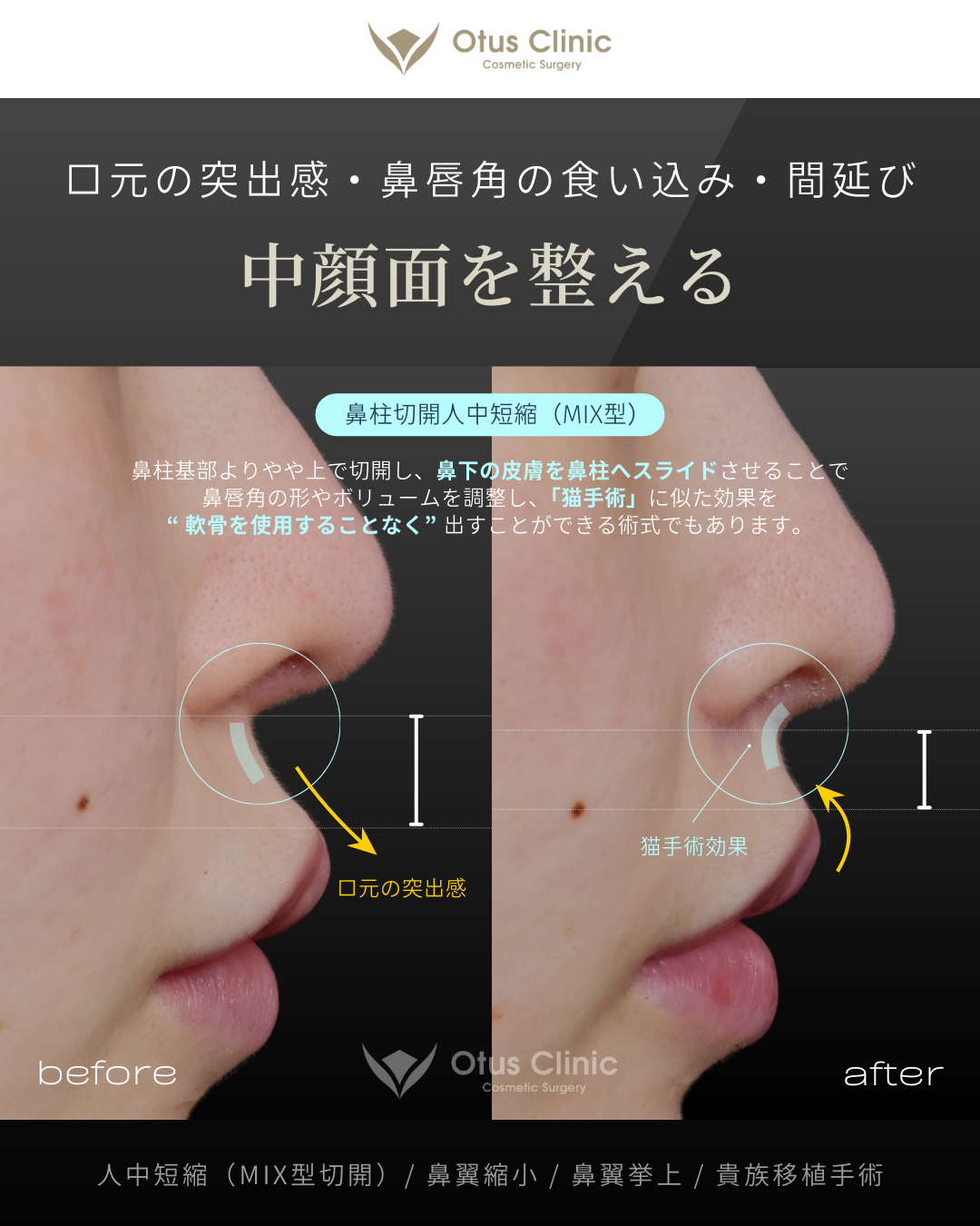人中短縮(鼻柱切開×鼻腔内切開)・鼻翼縮小・鼻翼挙上・貴族組織移植