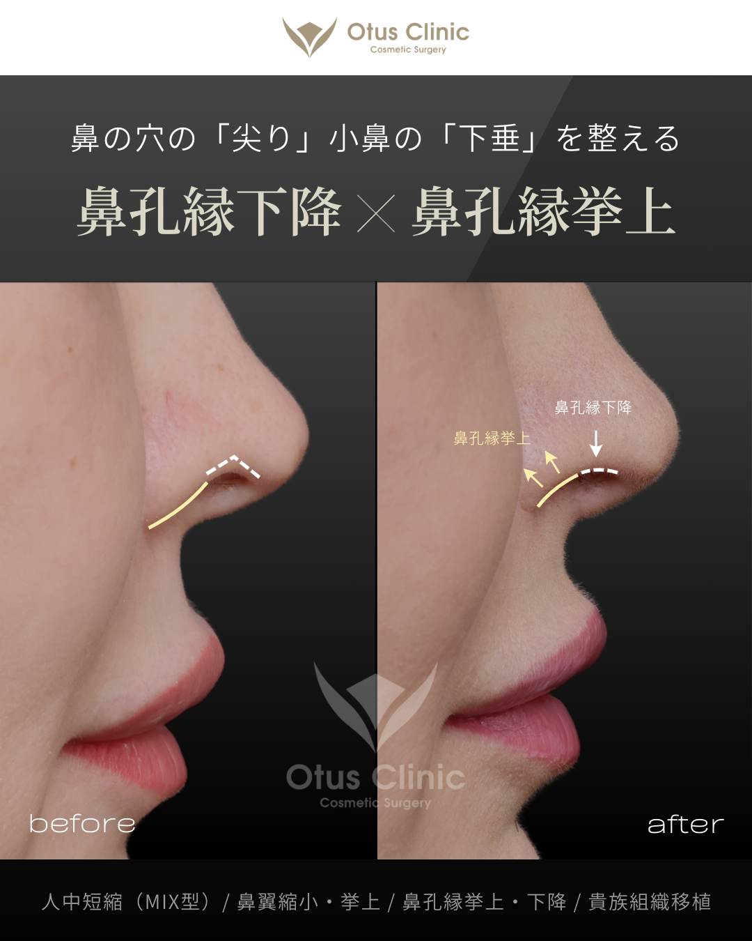 人中短縮（鼻柱切開×鼻腔内切開）・鼻翼縮小・鼻翼挙上・鼻孔縁挙上・鼻孔縁下降・貴族組織移植