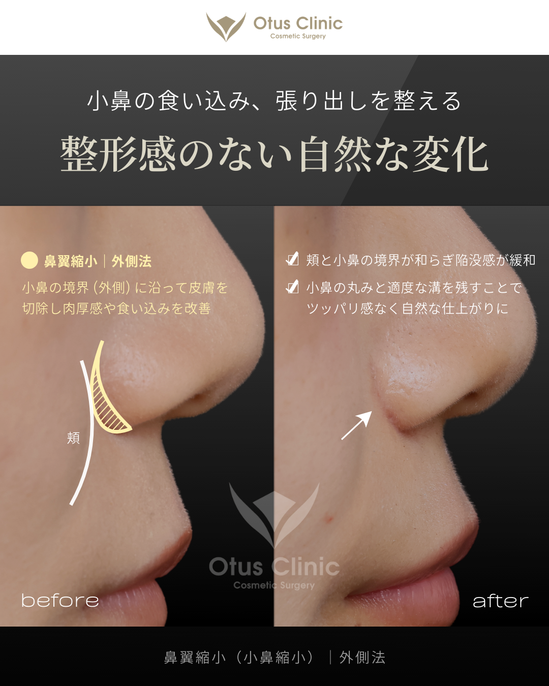 鼻翼縮小（小鼻縮小）｜外側法