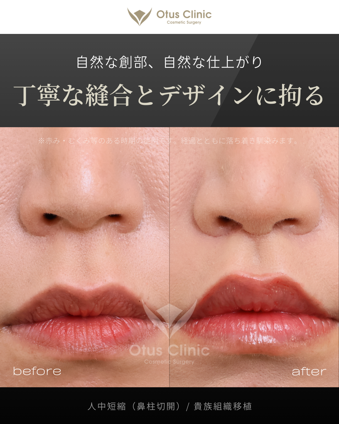 鼻柱切開人中短縮・貴族組織移植