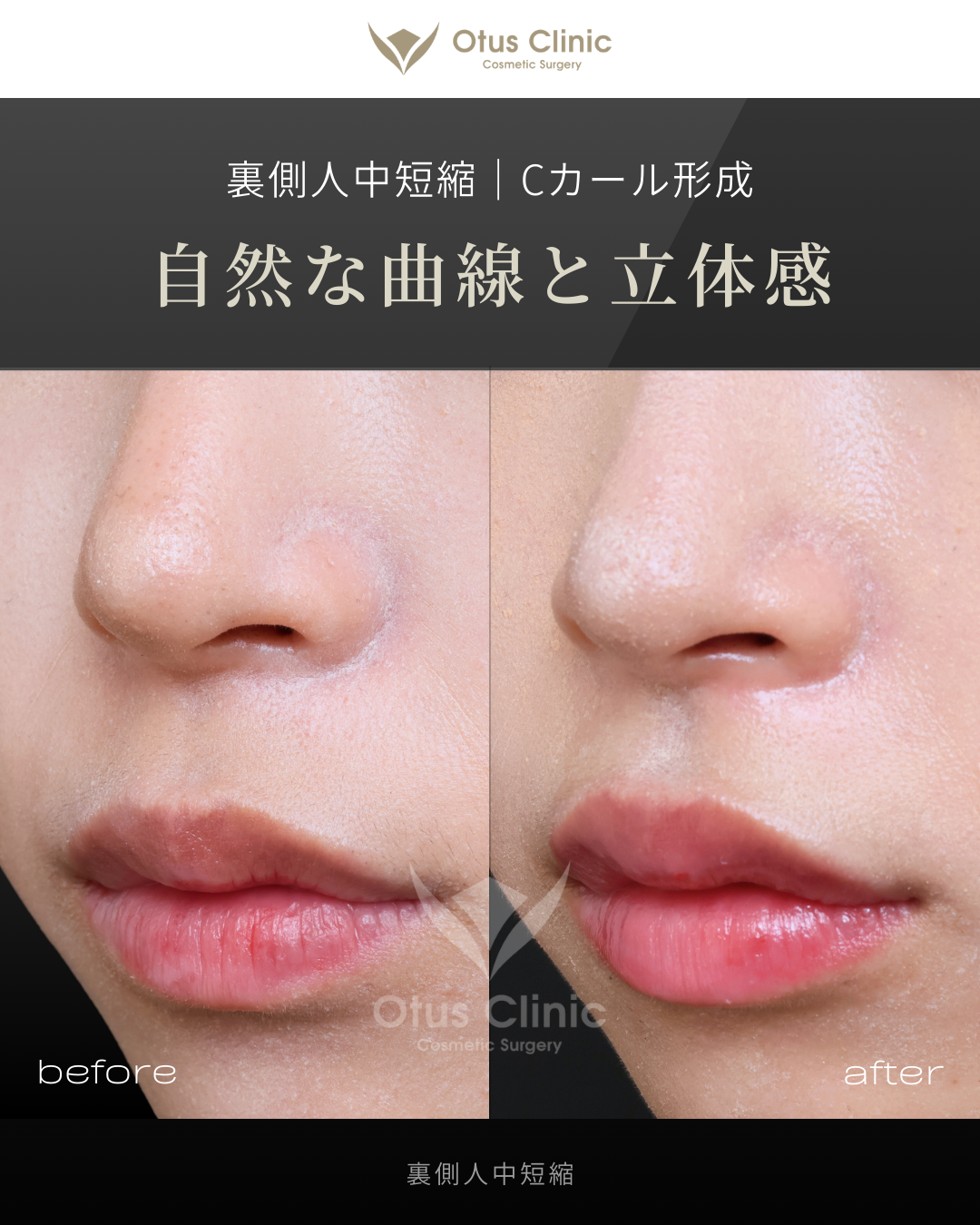 裏側人中短縮（切らない人中短縮）