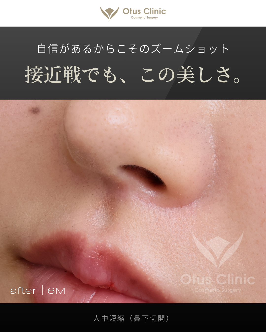 人中短縮（鼻下切開）