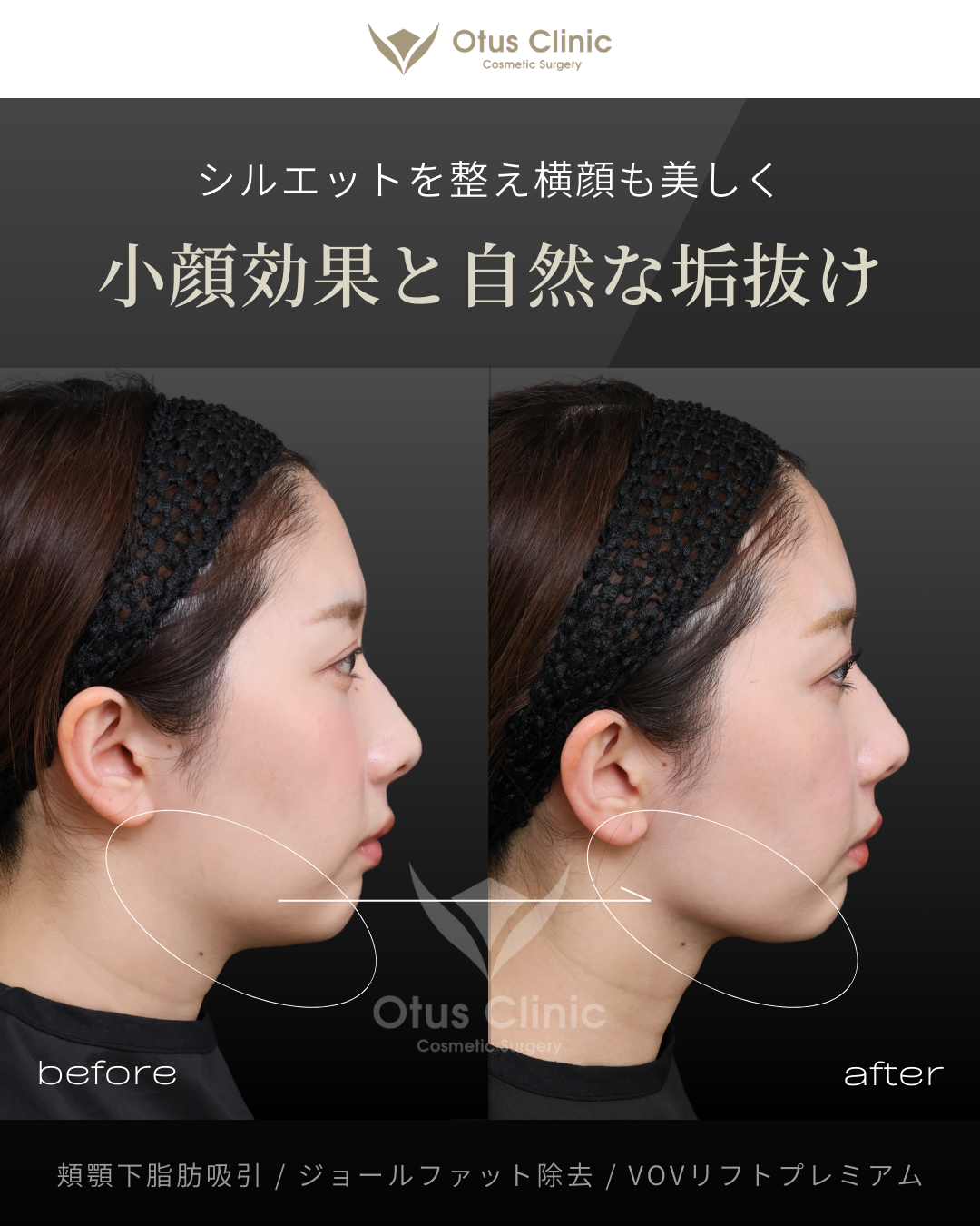 頬顎下脂肪吸引 ・ジョールファット除去 ・VOVリフトプレミアム
