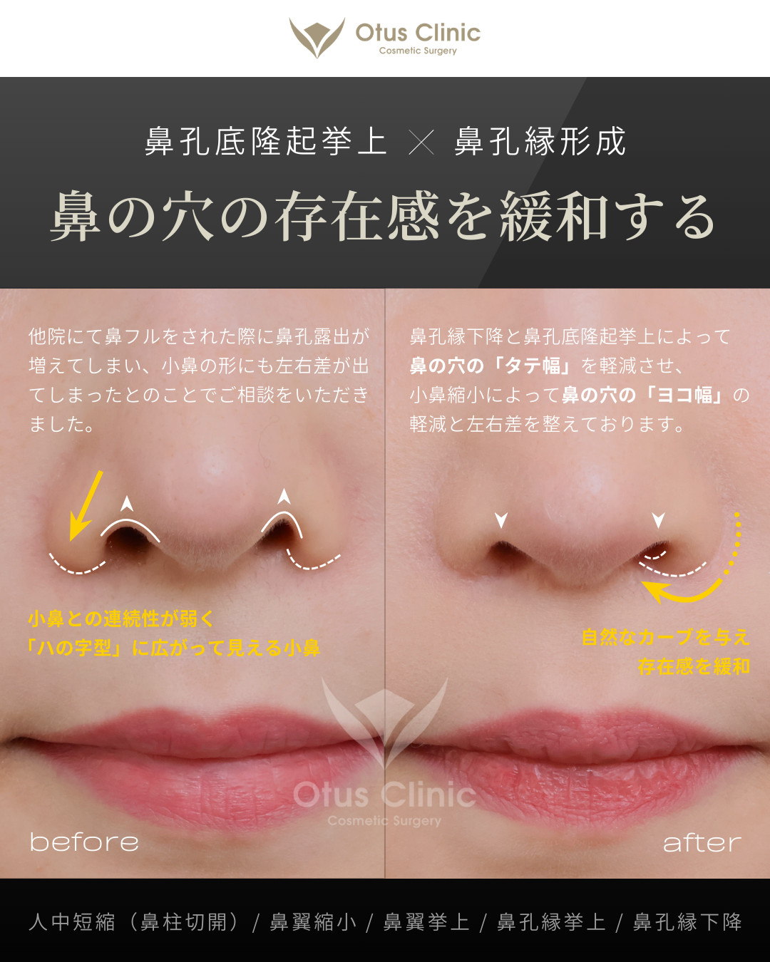 鼻柱切開人中短縮・鼻翼縮小・鼻翼挙上・鼻孔縁挙上・鼻孔縁下降