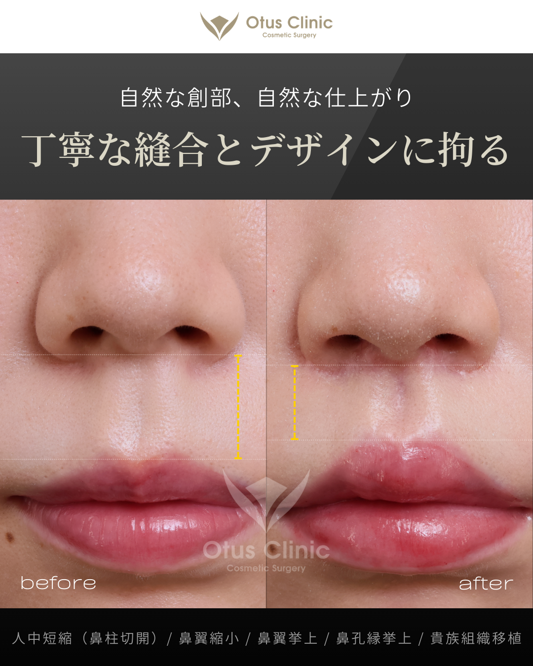 鼻柱切開人中短縮・鼻翼縮小・鼻翼挙上・鼻孔縁挙上・貴族組織移植