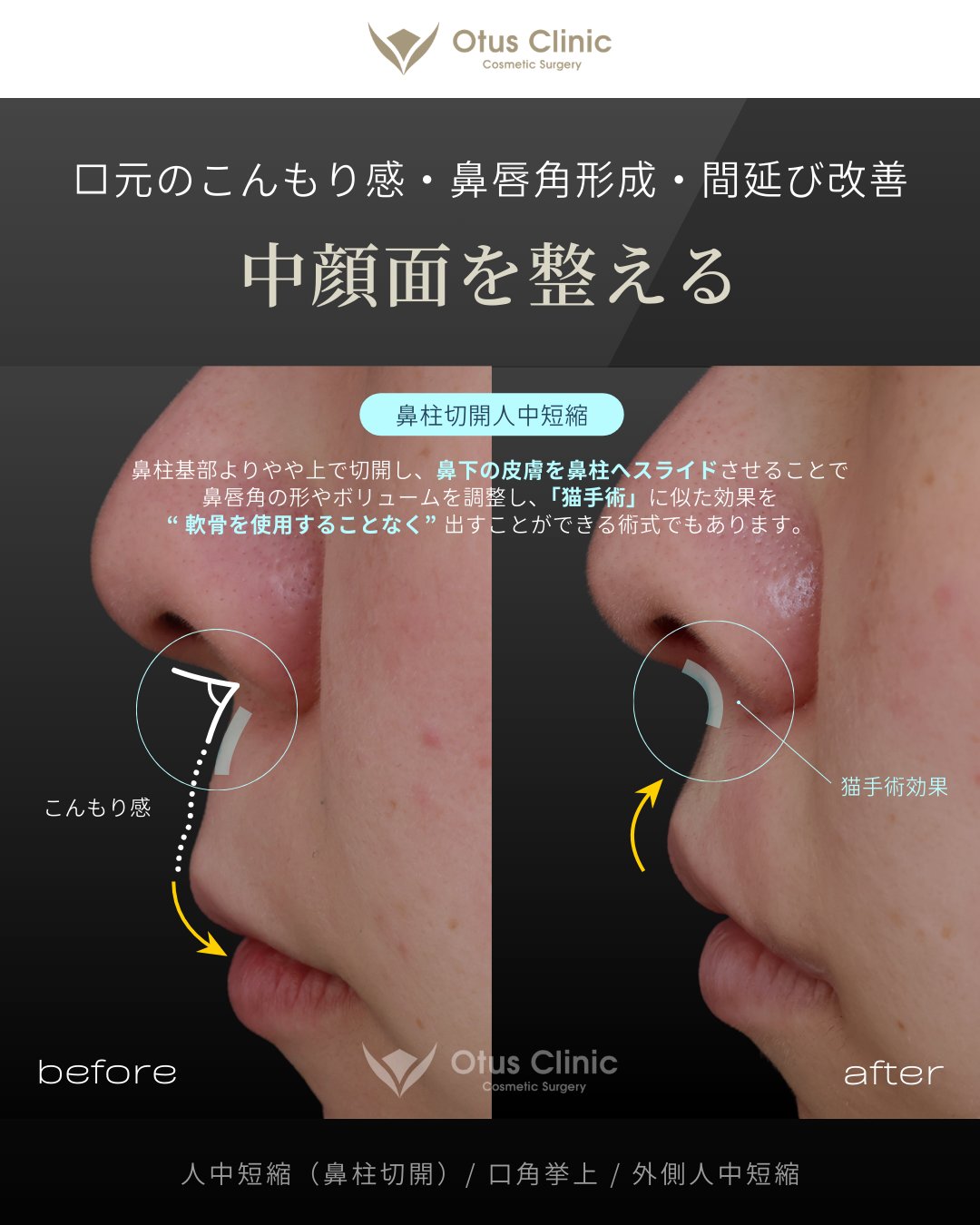 鼻柱切開人中短縮・口角挙上・外側人中短縮
