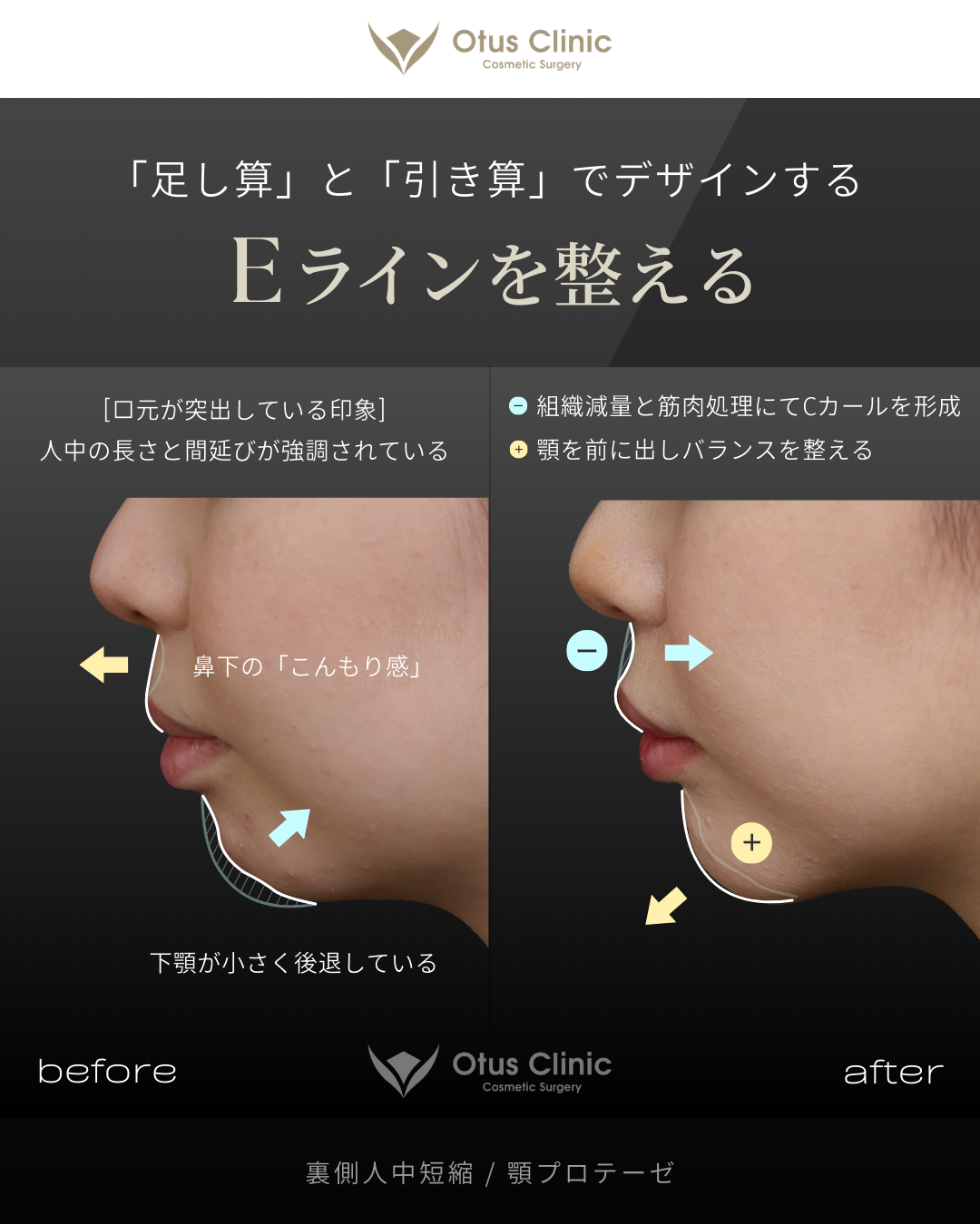 裏側人中短縮（切らない人中短縮）・顎プロテーゼ