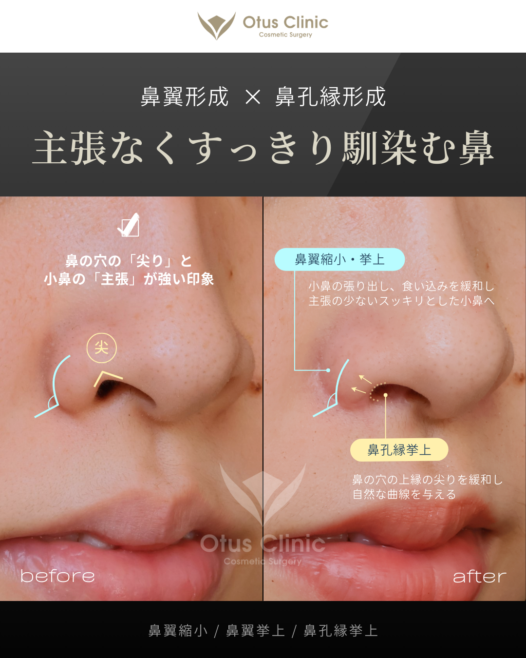 鼻翼縮小・鼻翼挙上・鼻孔縁挙上
