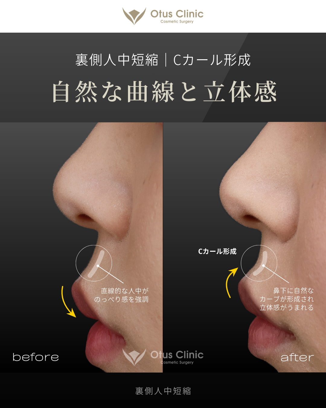 裏側人中短縮（切らない人中短縮）