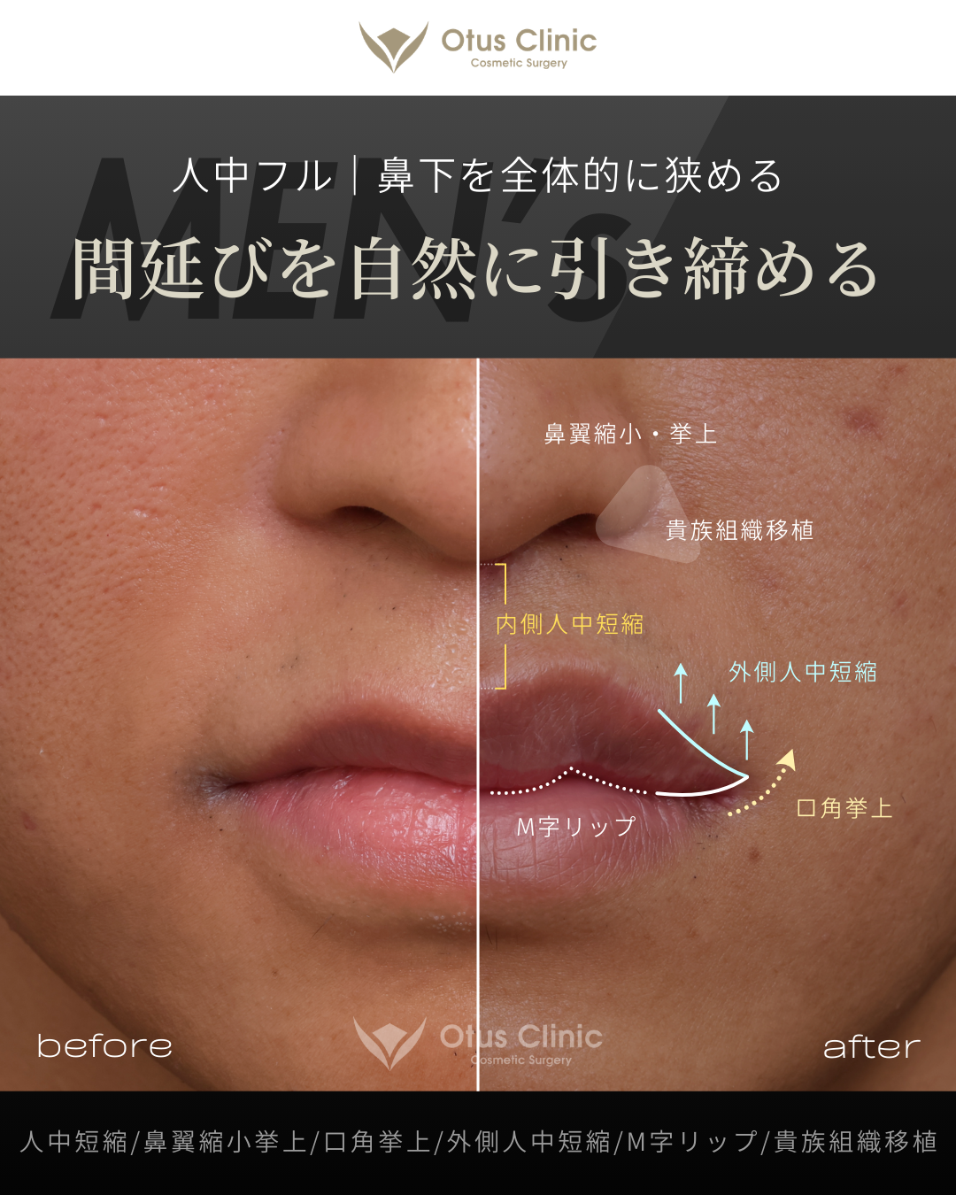 人中フル（人中短縮 / 鼻翼縮小 / 鼻翼挙上 / 外側人中短縮 / 口角挙上）・M字リップ ・貴族組織移植