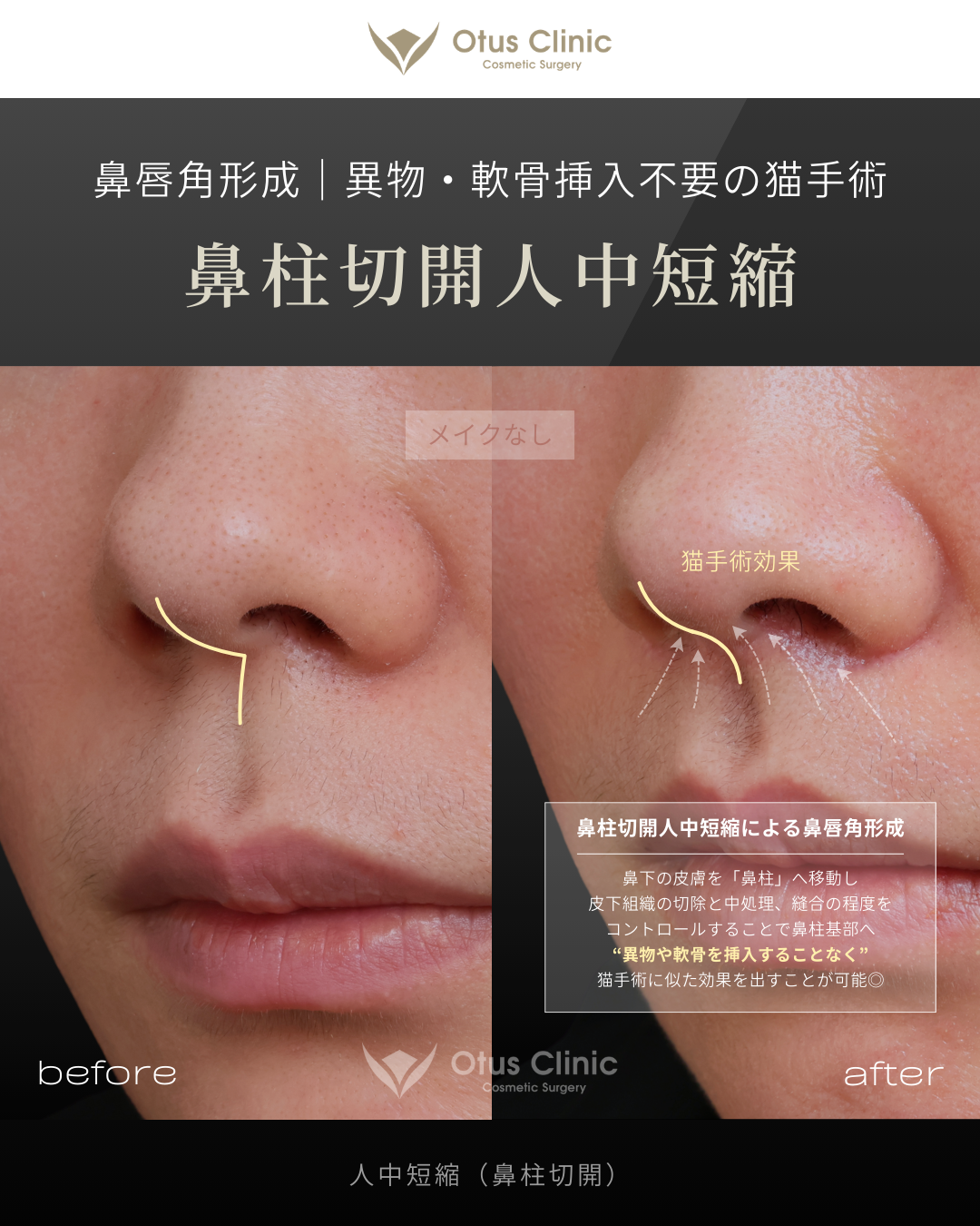 鼻柱切開人中短縮