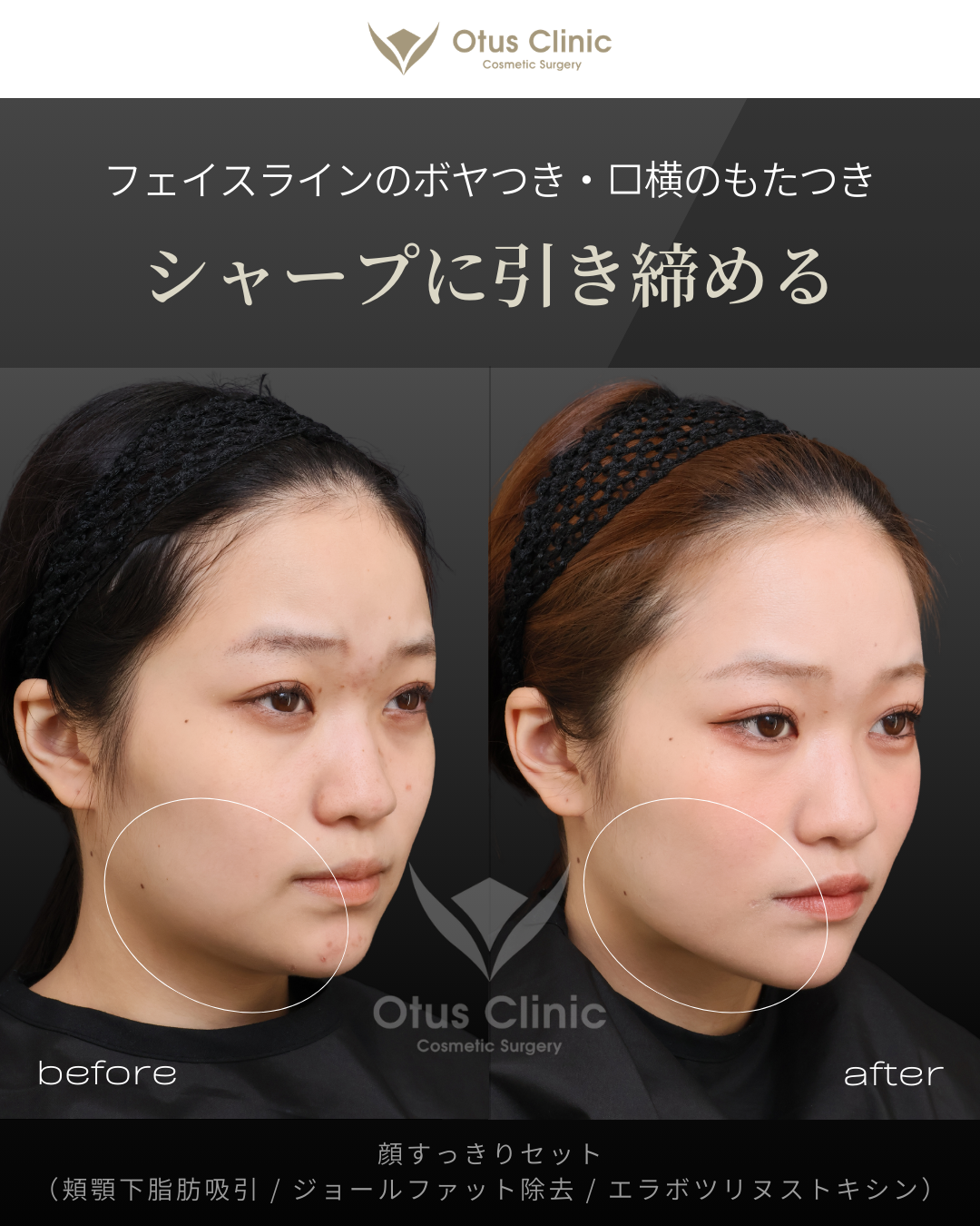 頬顎下脂肪吸引 ・ジョールファット除去 ・ エラBTX