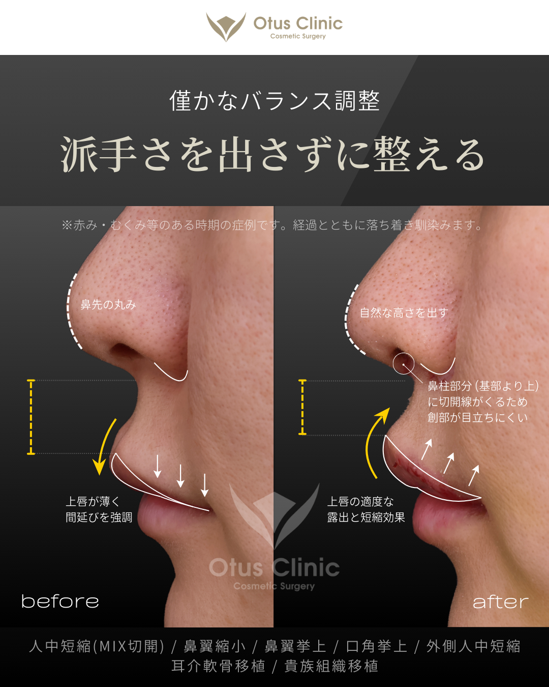 人中短縮(鼻柱切開×鼻孔内切開)・鼻翼縮小・鼻翼挙上・口角挙上・外側人中短縮・貴族組織移植・耳介軟骨移植