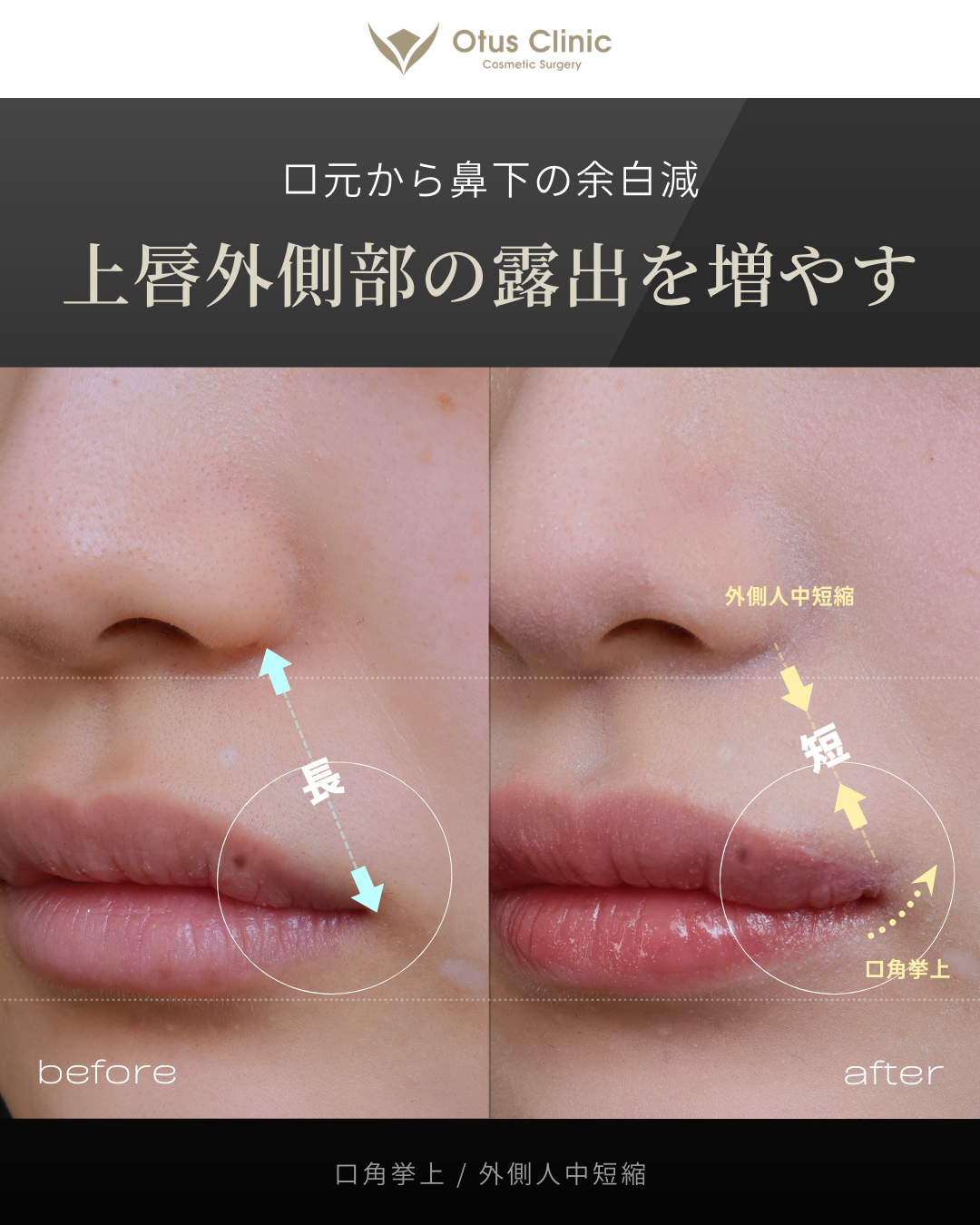 口角挙上・外側人中短縮