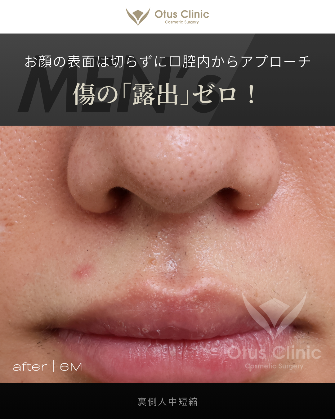 裏側人中短縮（切らない人中短縮）