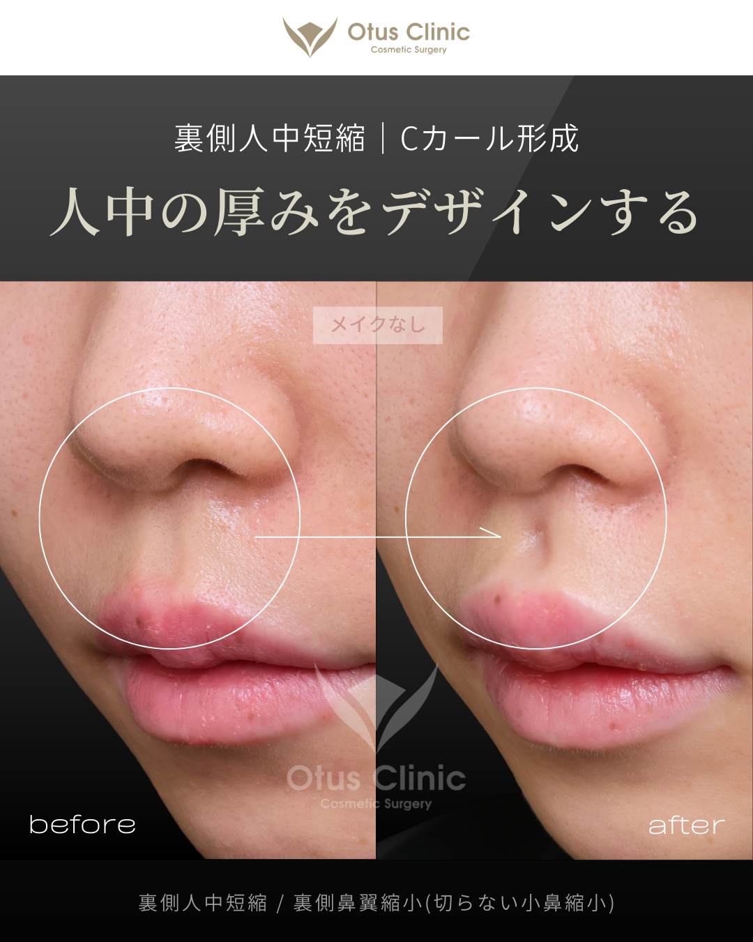 裏側人中短縮（切らない人中短縮）・裏側鼻翼縮小（切らない小鼻縮小）