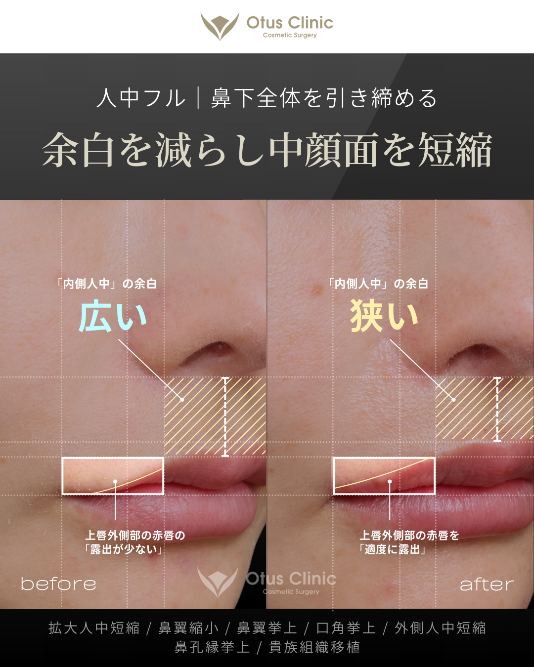 人中フル（人中短縮＋鼻翼縮小＋鼻翼挙上＋口角挙上＋外側人中短縮）・拡大人中短縮・貴族組織移植・鼻孔縁挙上