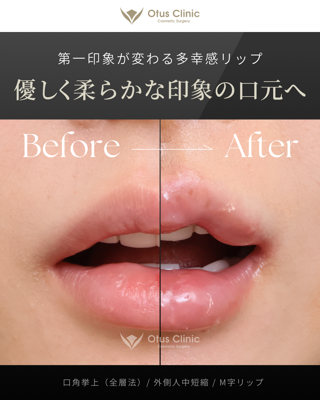 口角挙上（全層法）・外側人中短縮・M字リップ