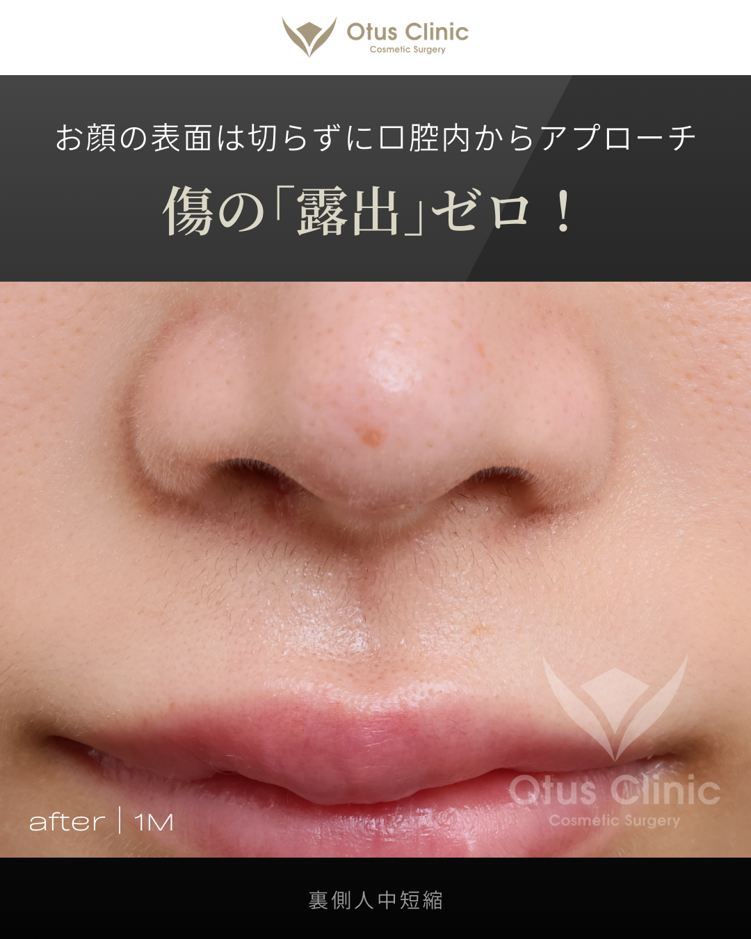 裏側人中短縮（切らない人中短縮）