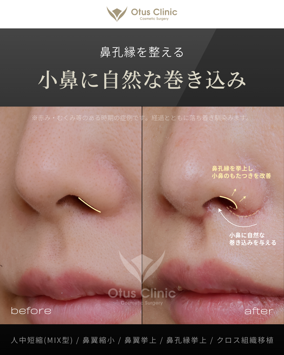 人中短縮(鼻柱切開×鼻腔内切開)・鼻翼縮小・鼻翼挙上・鼻孔縁挙上・クロス組織移植