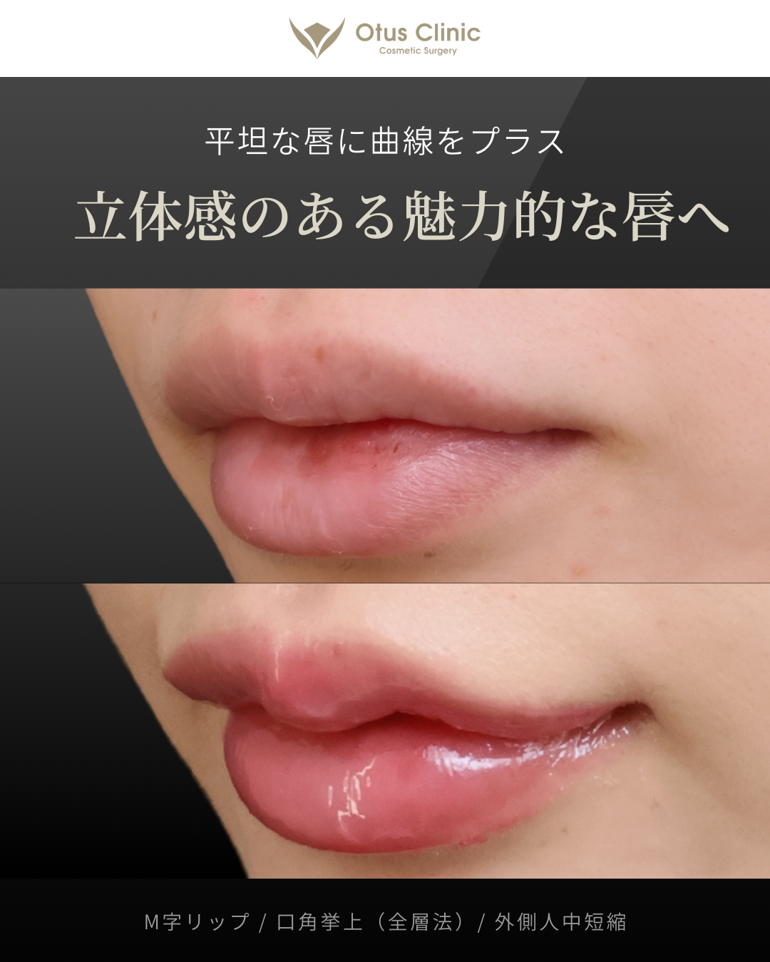 M字リップ ・鼻孔縁挙上 ・人中フル（人中短縮 / 鼻翼縮小 / 鼻翼挙上 / 外側人中短縮 / 口角挙上）