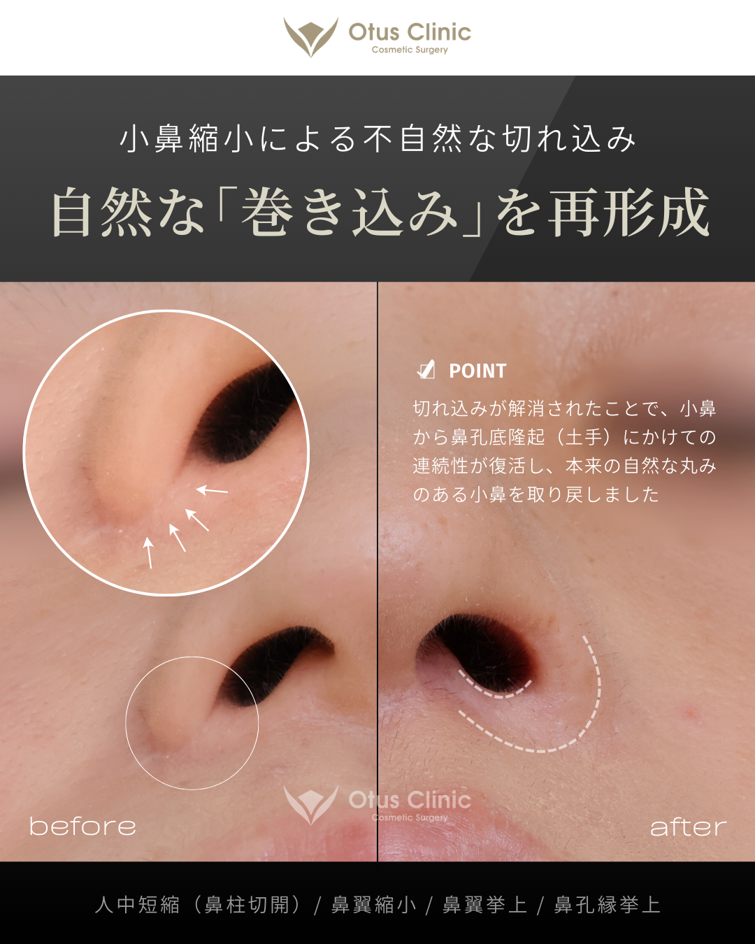 鼻柱切開人中短縮・鼻翼縮小・鼻翼挙上・鼻孔縁挙上