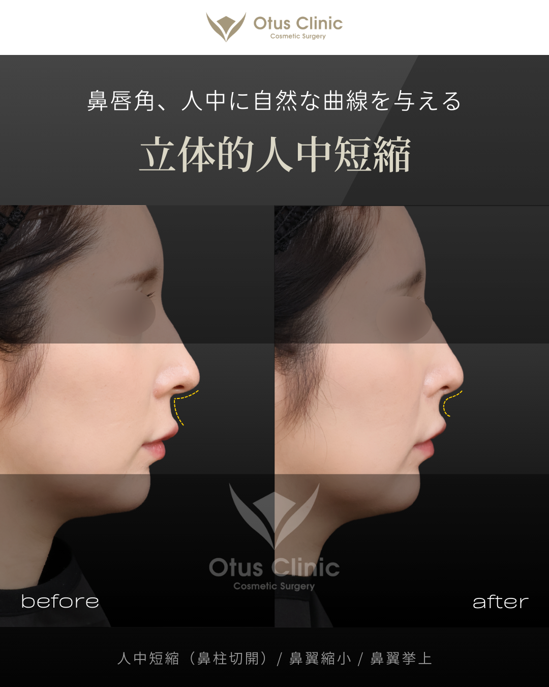 鼻柱切開人中短縮・鼻翼縮小・鼻翼挙上