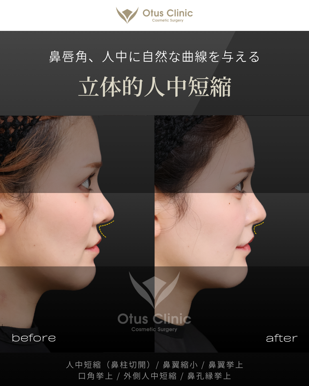 鼻柱切開人中短縮・鼻翼縮小・鼻翼挙上・口角挙上・外側人中短縮 ・鼻孔縁挙上