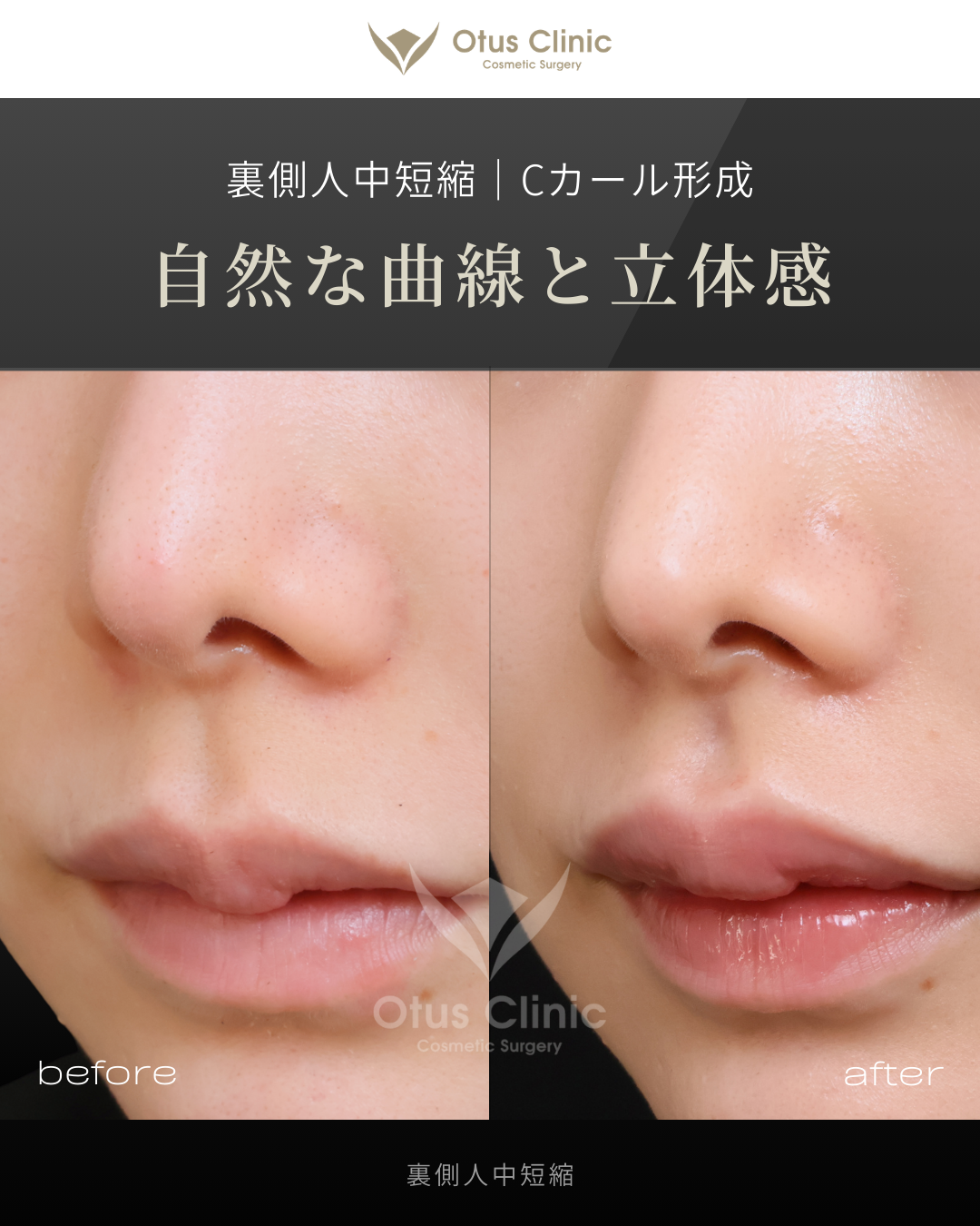 裏側人中短縮（切らない人中短縮）