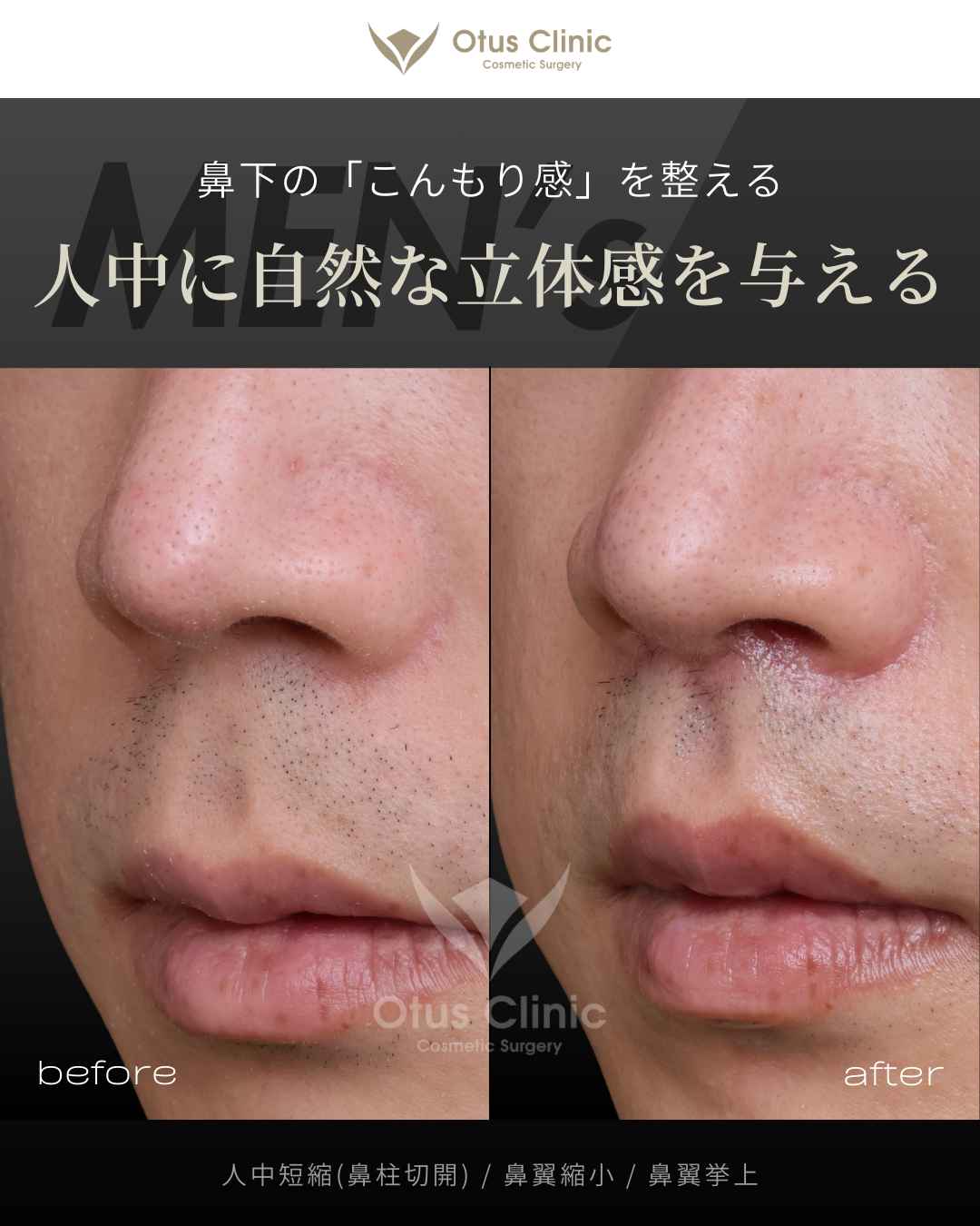 鼻柱切開人中短縮・鼻翼縮小・鼻翼挙上
