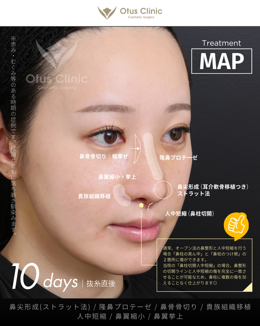 鼻尖形成(耳介軟骨移植つき)・ストラット法・隆鼻プロテーゼ・鼻骨骨切り・貴族組織移植・鼻柱切開人中短縮・鼻翼縮小・鼻翼挙上