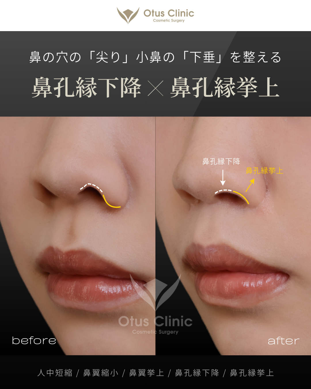 人中短縮・鼻翼縮小・鼻翼挙上・鼻孔縁下降・鼻孔縁挙上