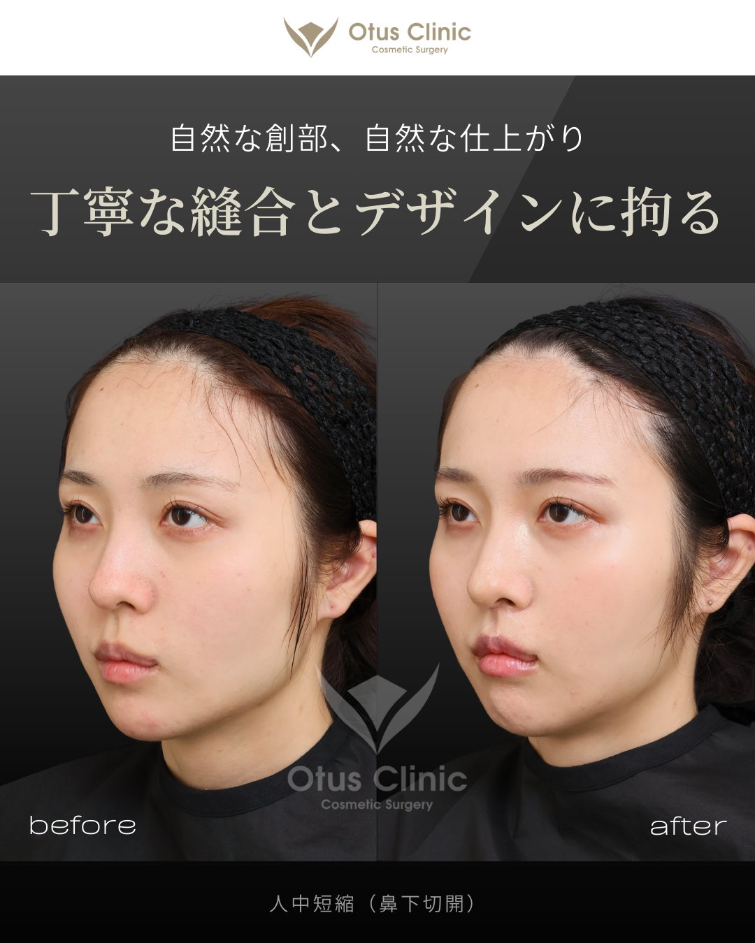 人中短縮(鼻下切開)