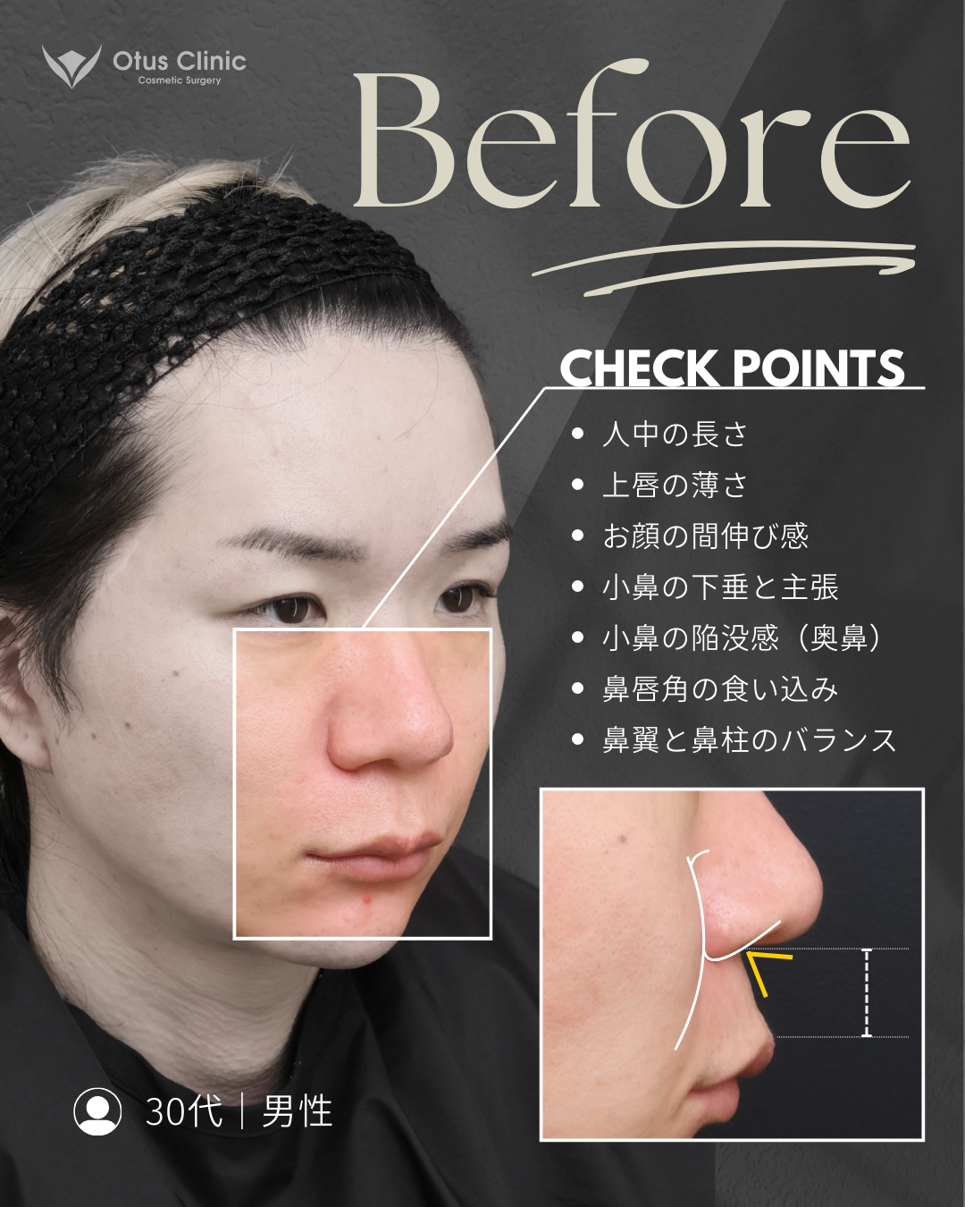 鼻柱切開人中短縮・鼻翼縮小・鼻翼挙上・貴族組織移植・鼻孔縁挙上 ・鼻尖形成（耳介軟骨移植付き）・ストラット法