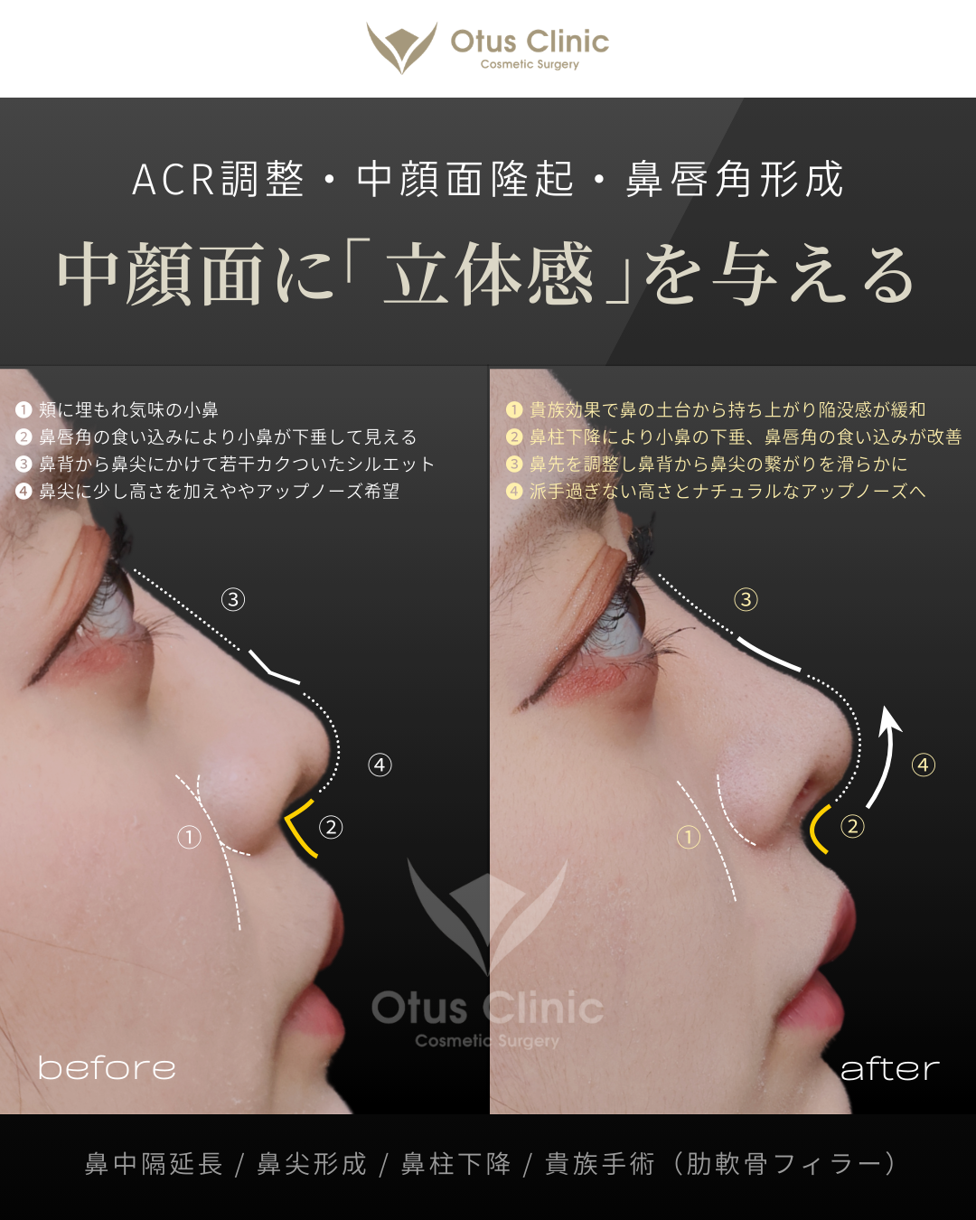 鼻中隔延長（肋軟骨）・鼻尖形成・鼻柱下降・貴族手術（肋軟骨フィラー）