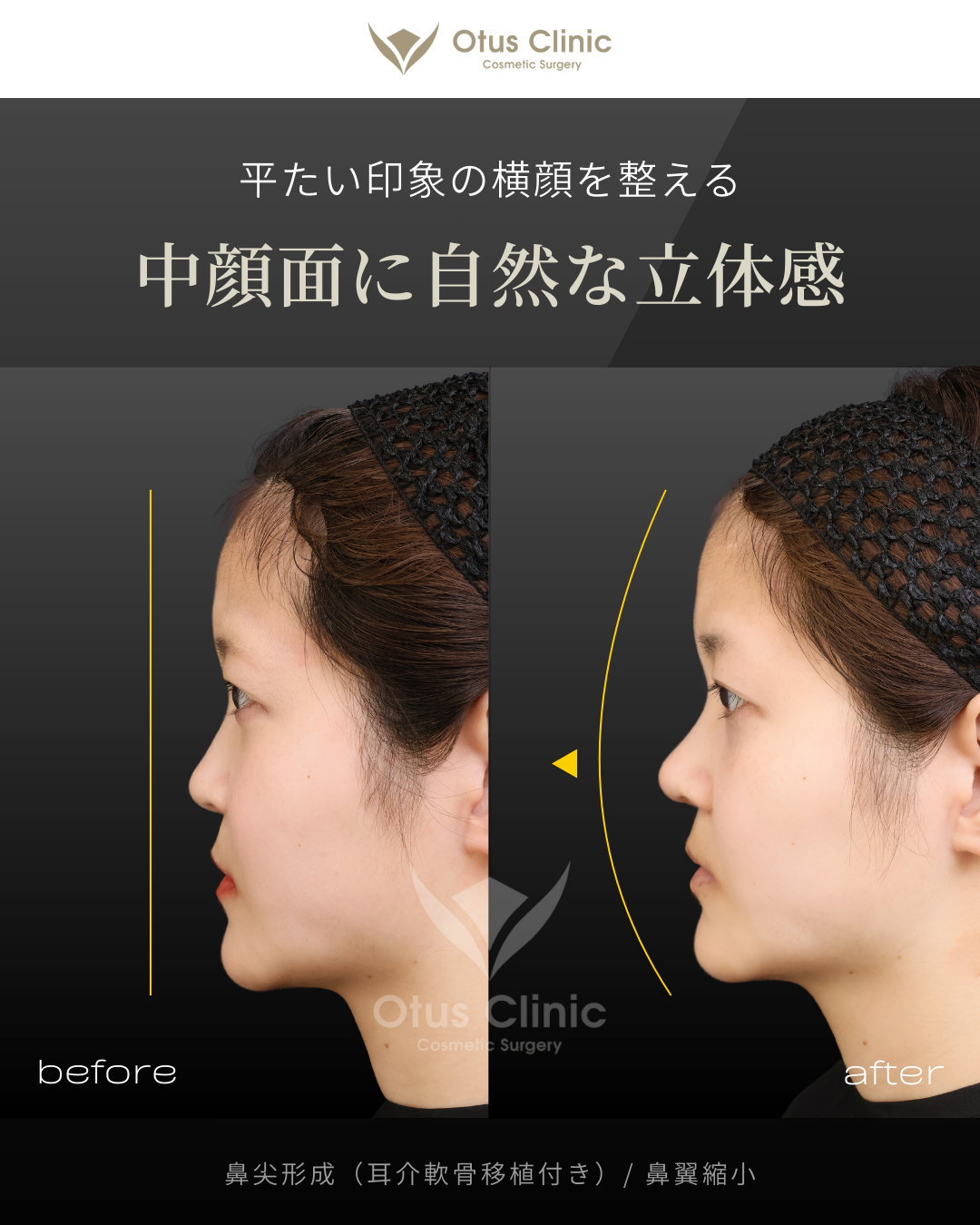 鼻尖形成（耳介軟骨移植付き）・鼻翼縮小