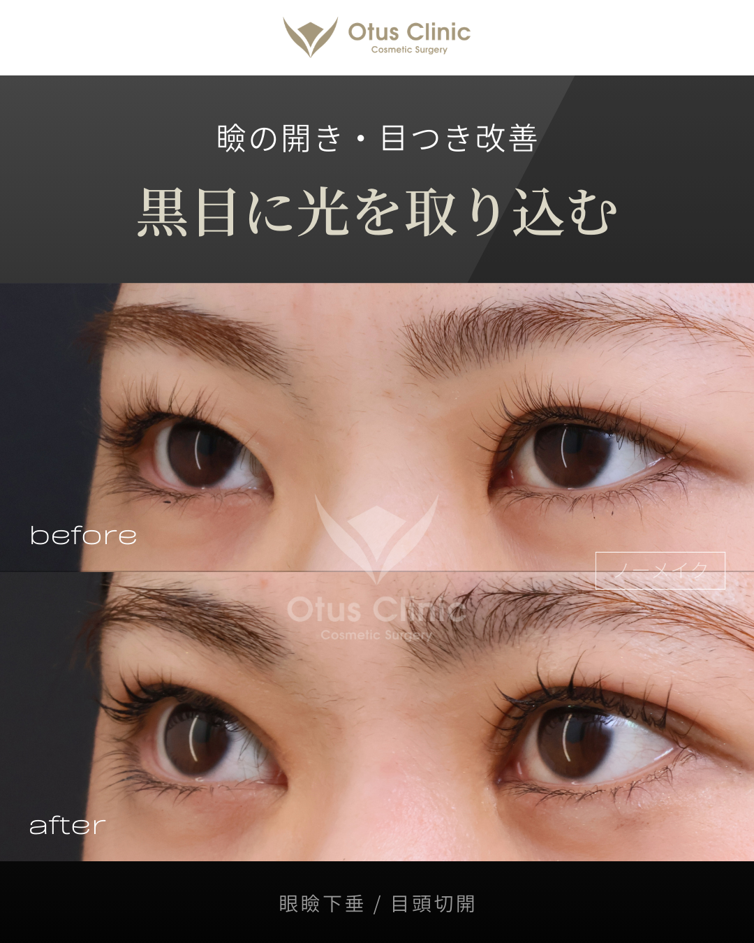 眼瞼下垂・目頭切開