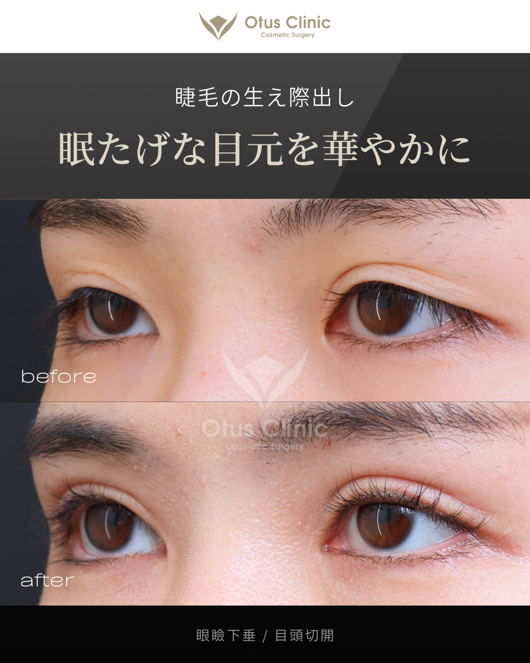 眼瞼下垂・目頭切開