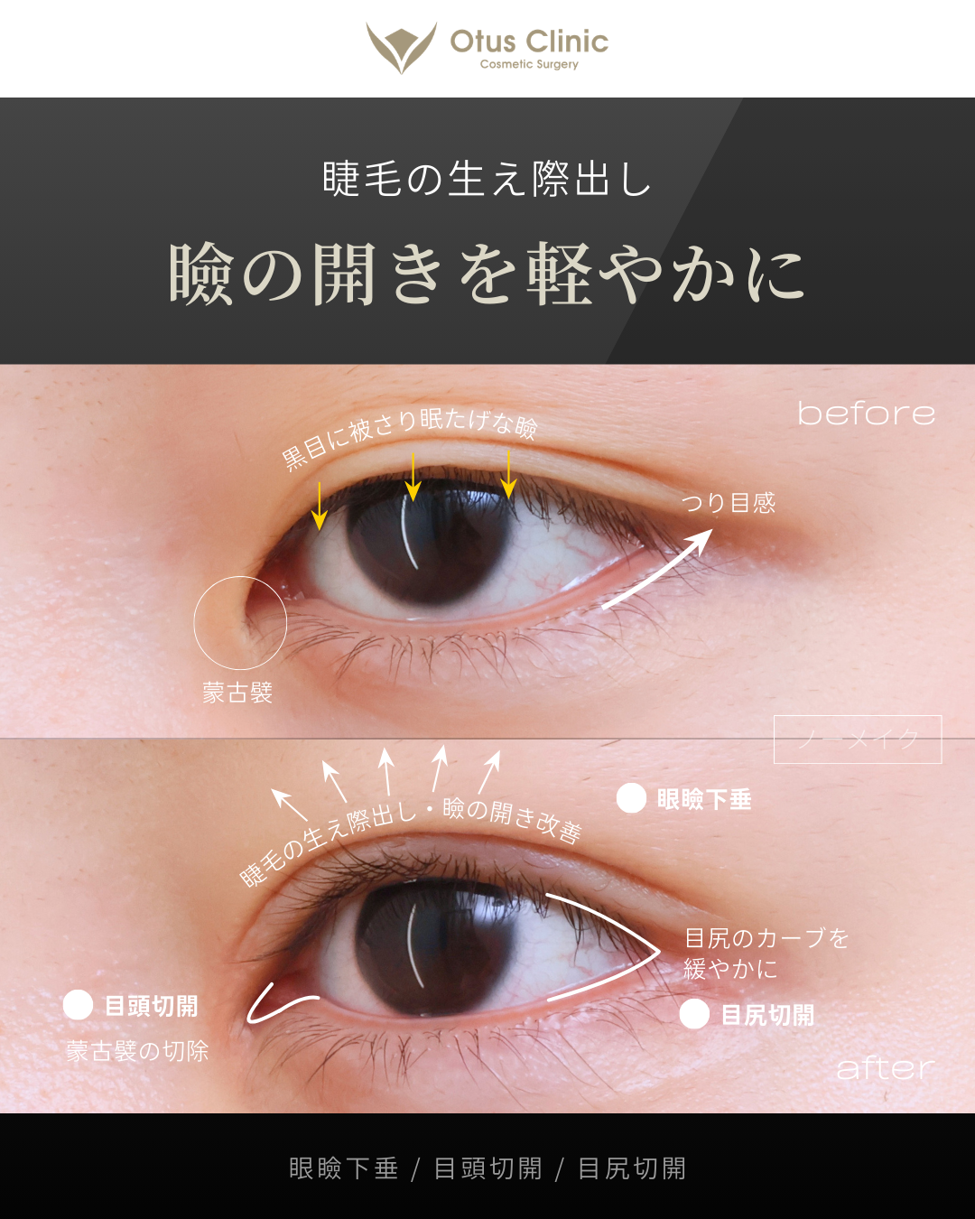 眼瞼下垂・目頭切開・目尻切開